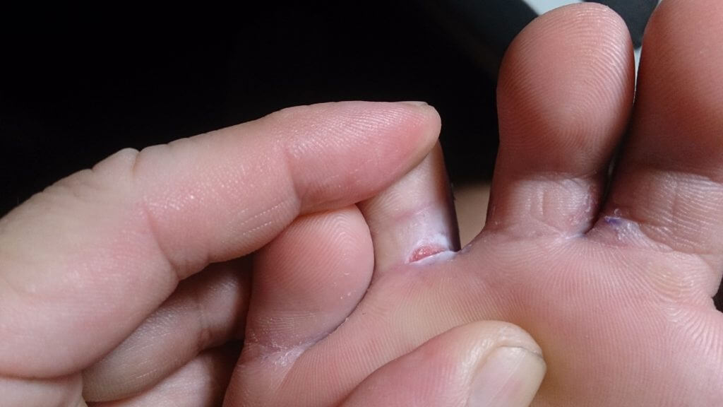 Home Remedies for Athlete’s Foot