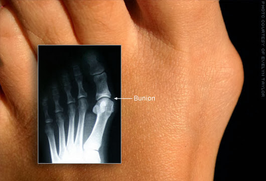 Bunions: What in the World Causes Them?