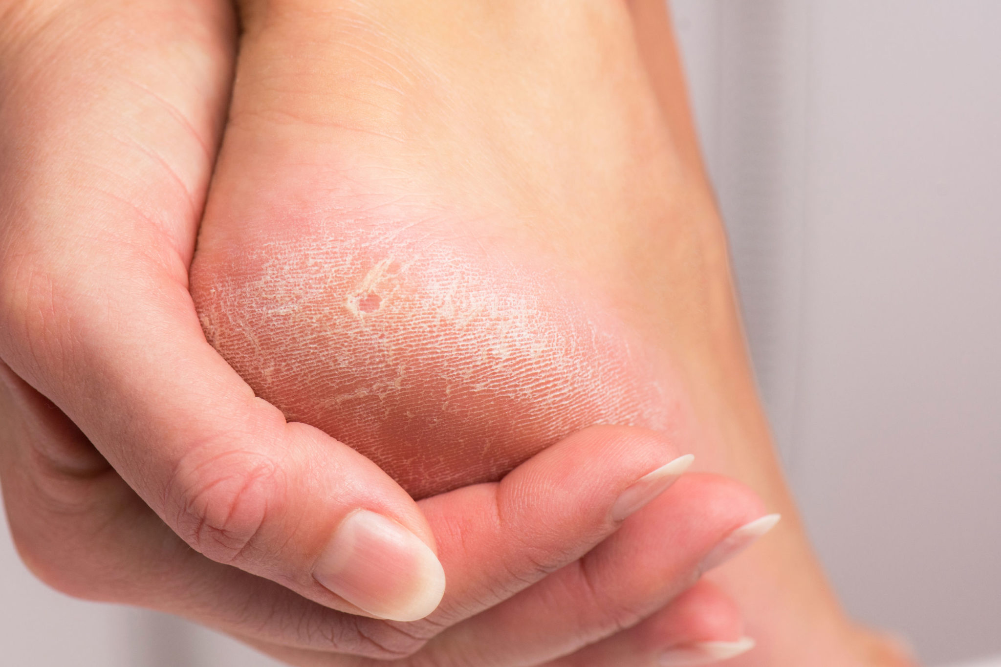 5-reasons-why-you-keep-getting-calluses-on-feet-elizabeth-e-auger-dpm